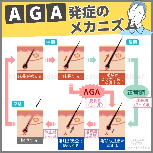 AGA発症メカニズム