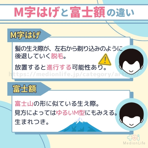 M字はげと富士額の違い