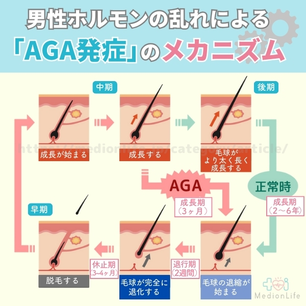 AGA発症のメカニズム