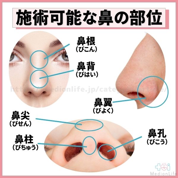 鼻整形 施術可能部位
